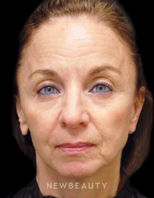 Dr. Janet Allenby - Injectables - Before