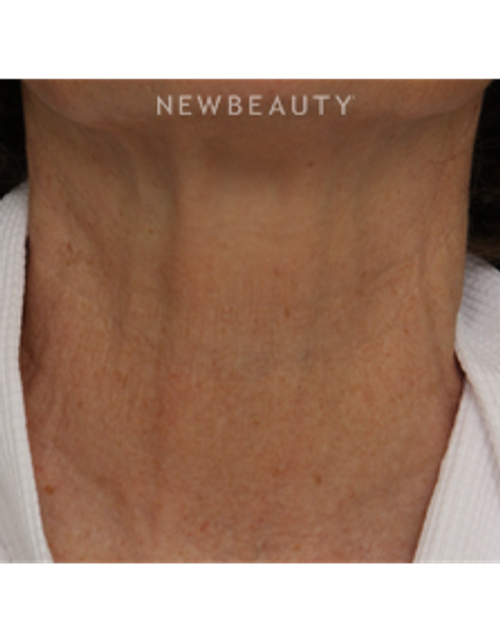 Drs. Jennifer Segal & Scott Smith - Microneedling - After