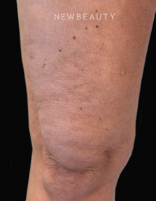 Dr. Julie Russak - Skin Tightners - Before