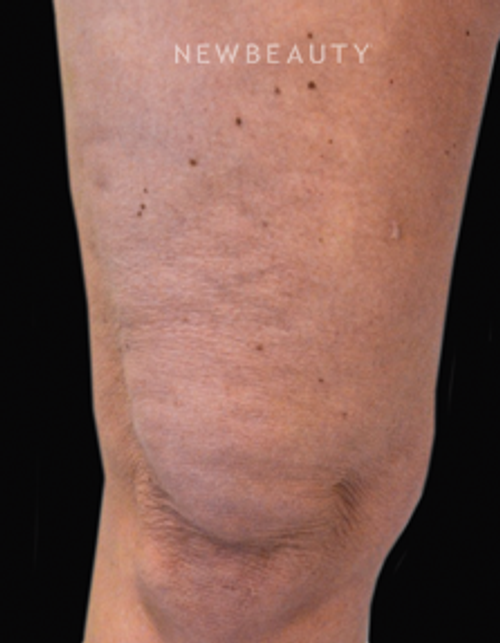 Dr. Julie Russak - Skin Tightners - Before