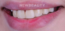 Dr. Husam Almunajed – Smile Makeover - 32902668 - Before