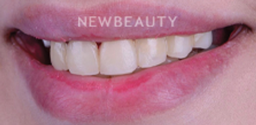 Dr. Husam Almunajed  – Smile Makeover - 32902668 - Before