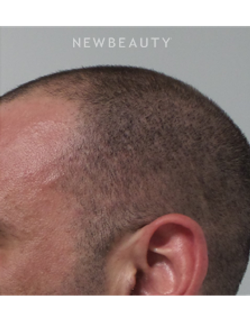 Dr. Marina Peredo - Hair-Loss Treatment - After