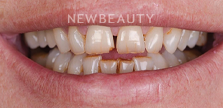 Dr. Husam Almunajed - Smile Makeover - 41358214 - Before