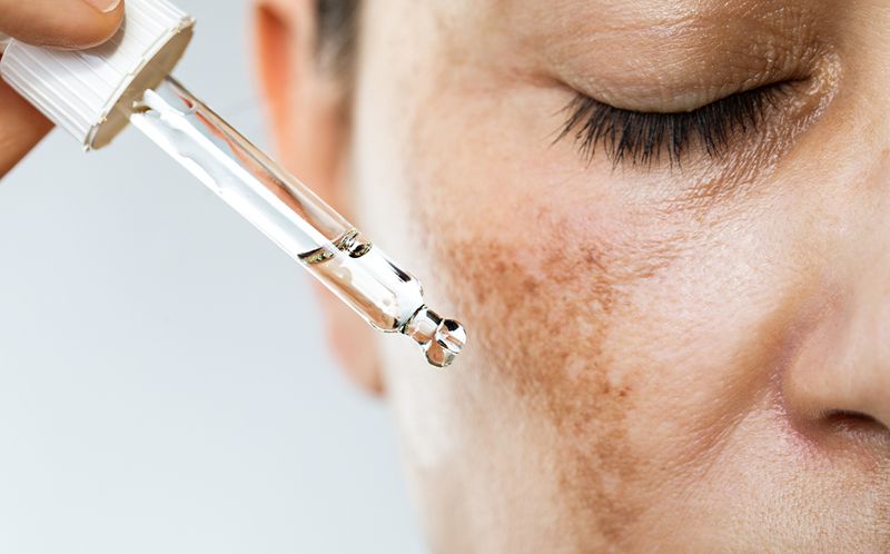 Tranexamic acid for melasma