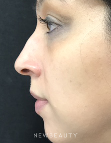 Dr. Julie Russak - Nonsurgical Rhinoplasty - Before