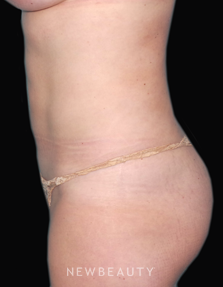 Dr. Sean Simon Laser Liposuction - After