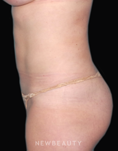 Dr. Sean Simon Laser Liposuction - After
