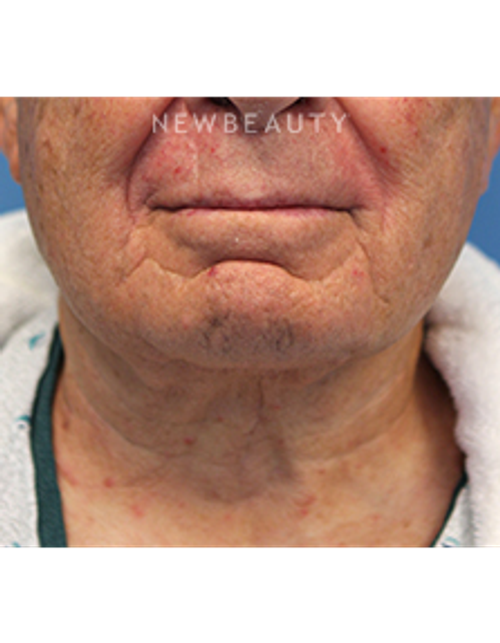 Dr. Christine Hamori - Necklift - After