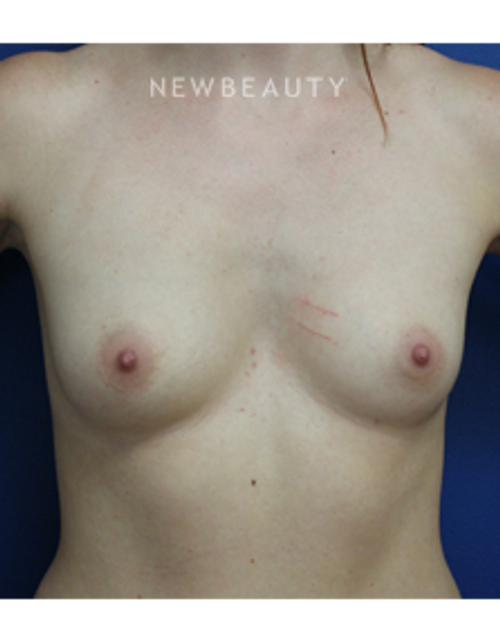 Dr. Joseph Russo - Volume Boost (Breast EBG) - Before