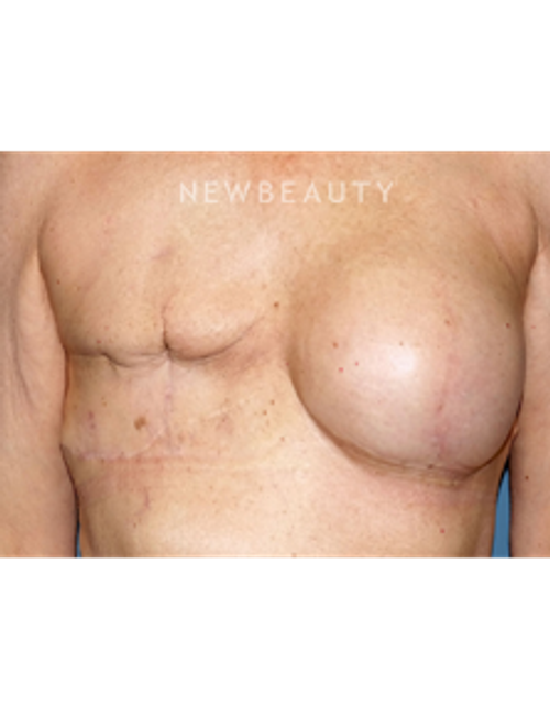 Dr. Bryan Gawley - Breast Reconstruction - Before