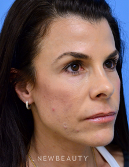 Dr. Mokhtar Asaadi - Matching Aesthetics - After