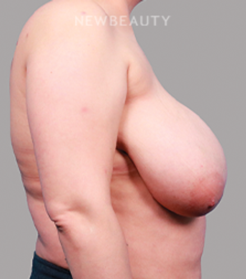 Dr. Michael Lofgren-Breast Reduction-44688490 - Before