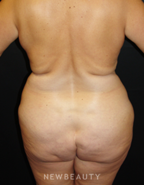 Dr. Mokhtar Asaadi Liposuction - Before