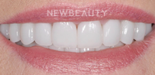 Dr. Salvator La Mastra - Smile Makeover - 46107405 - After