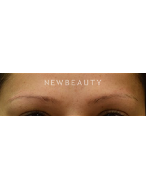 Dr. Jeffrey B. Wise - Eyebrow Hair Restoration - Before