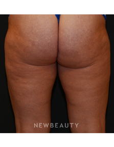 Dr. Janet Allenby - Body Sculpting - After