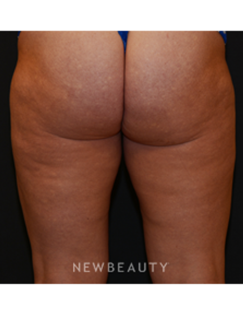Dr. Janet Allenby - Body Sculpting - After