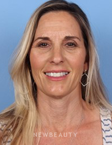 Dr. Kelly Bomer - Botox - Before