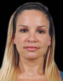 Dr. Kenneth Beer Injectables & Fillers - After