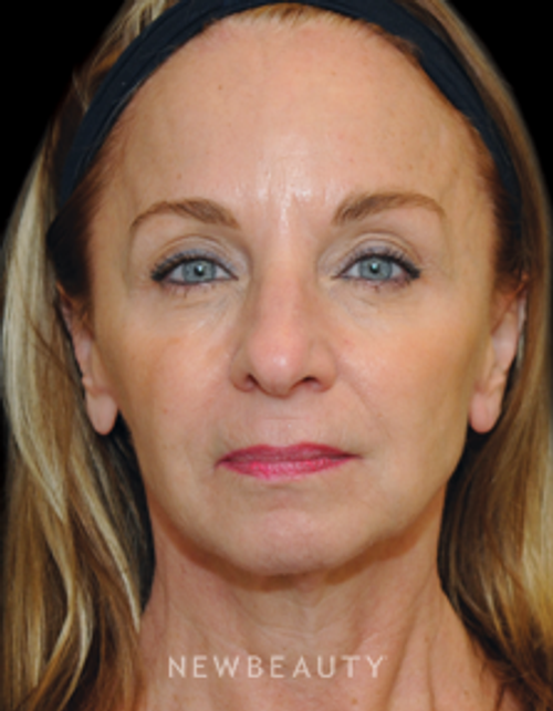 Dr. Janet Allenby - Injectables - After