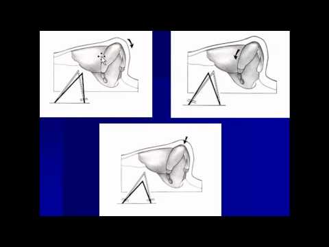 Dr. David Kim – Rhinoplasty – The Structural Approach To Rhinoplasty – Part 4