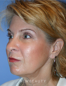 Dr. Kelly Bomer Liquid Facelift - After