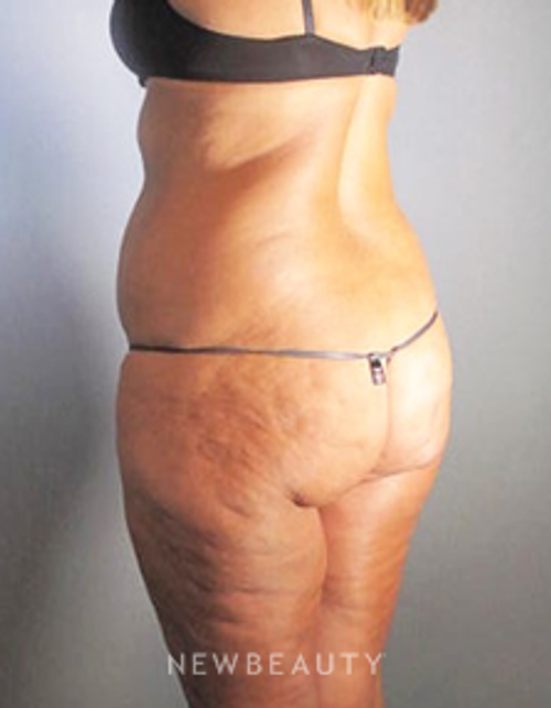 Dr. German Newall - Butt Augmentation - Before