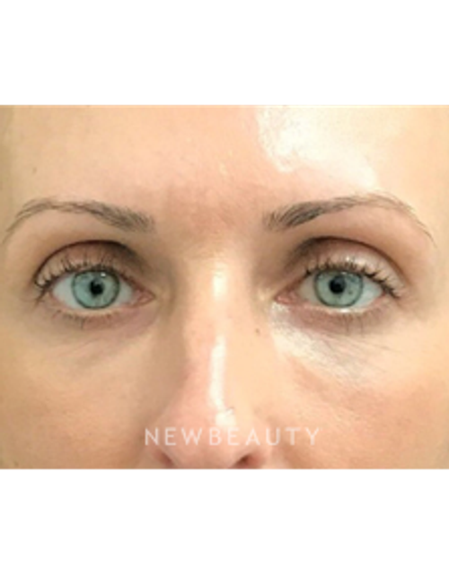 Dr. Janet Allenby - Injectables & Fillers - After
