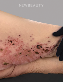 Dr. Anna Chacon - Calciphylaxis - 34279110 - After