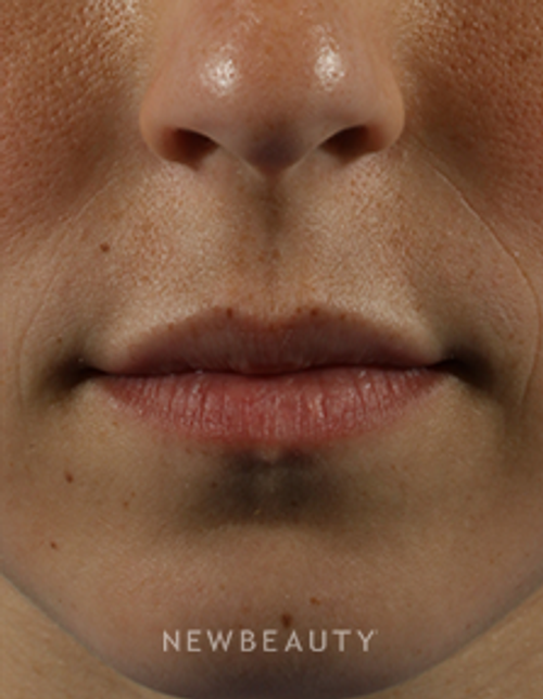 Dr. Marina Peredo - Restylane - Before