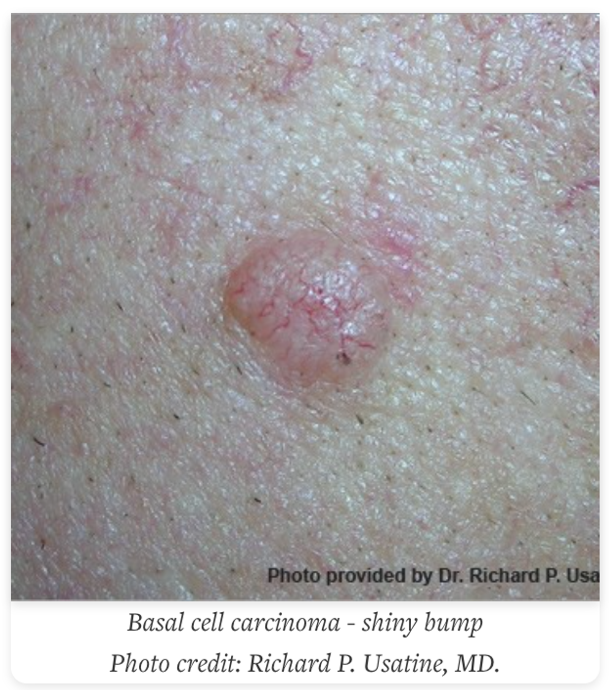 basal cell carcinoma 