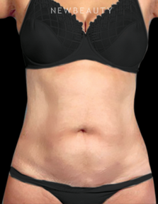 Dr. Henry Mentz - Tummy Tuck and Liposuction - Before