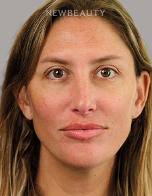 Dr. Deborah Longwill - Lip Filler - 46446227 - After
