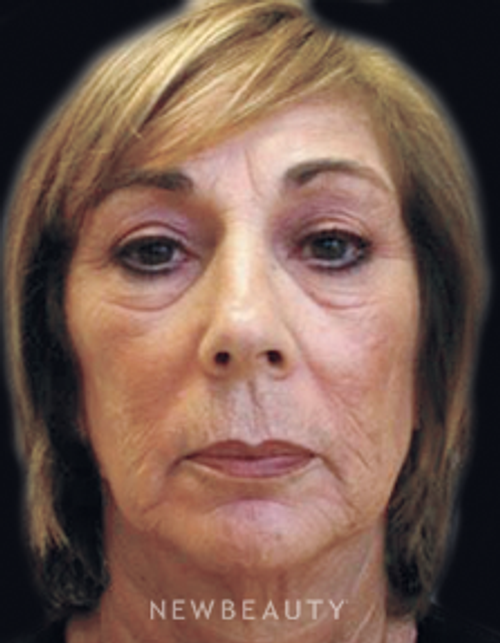Dr. Janet Allenby Injectables & Fillers - Before