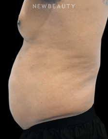 Dr. Janet Allenby - CoolTone - Before