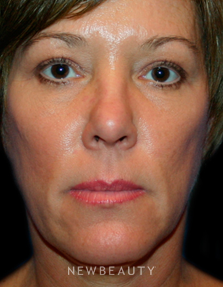 Dr. Kelly Bomer Eyelid Lift - Before