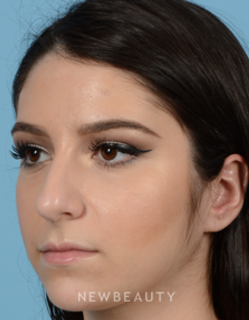 Dr. Jeffrey B. Wise - Rhinoplasty - Before