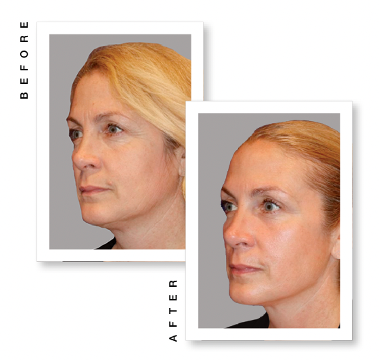 Ultherapy PRIME Ultherapy PRIME