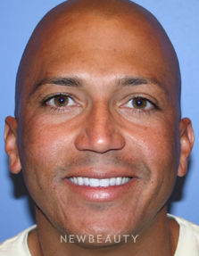 Dr. Kelly Bomer, Injections/Liquid Lift - After