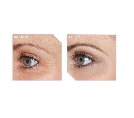 Before and after neurotoxins and eye filler