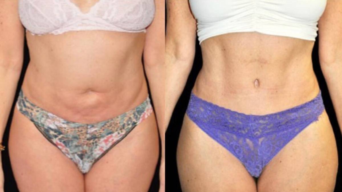 emsculpt-terner-before-after