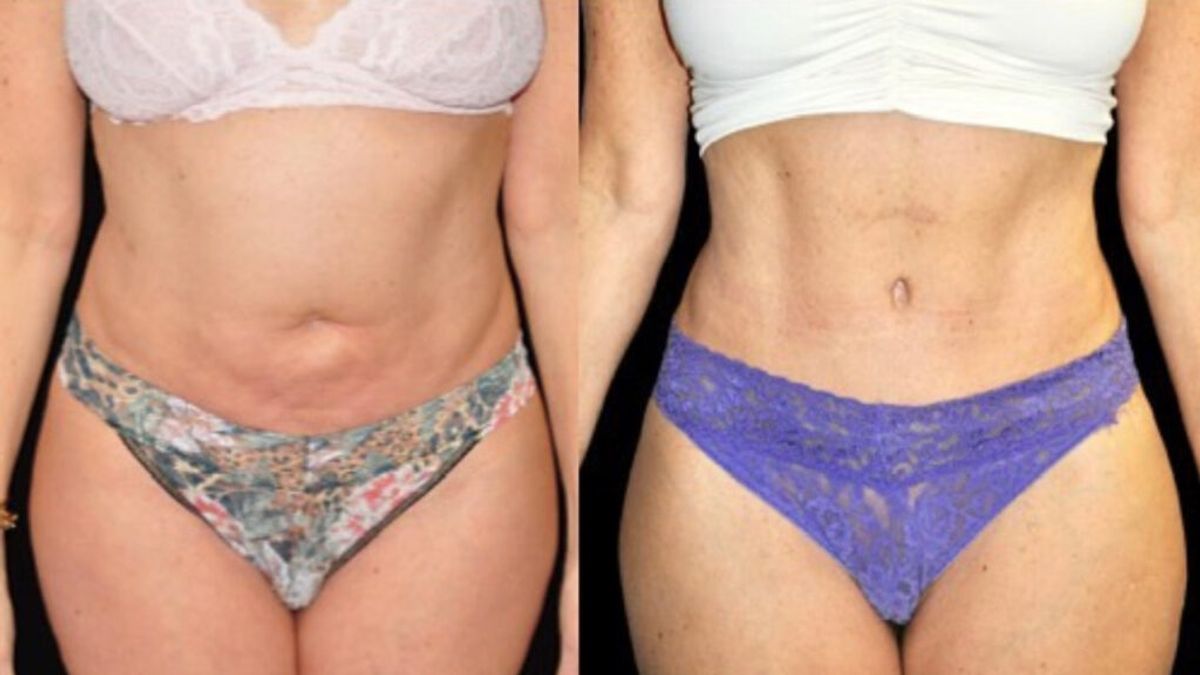 emsculpt-terner-before-after