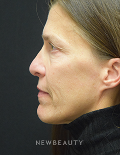 Dr. Jeffrey B. Wise - Rhinoplasty - After