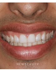 Dr. Joseph Field - Invisalign & Teeth Whitening - After
