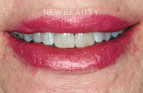 Guy M. Lewis, DDS - 23776910 - Dazzling Transformation - Before
