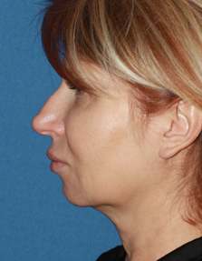 Dr. Konstantin Vasyukevich, Traditional Facelift - Before