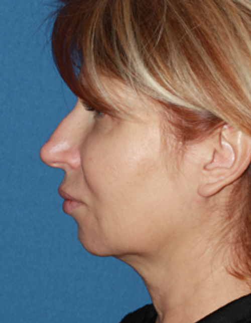 Dr. Konstantin Vasyukevich, Traditional Facelift - Before