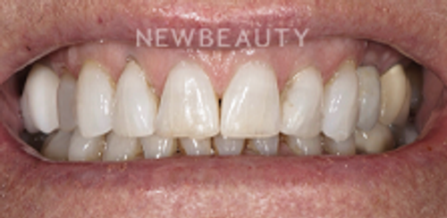 Dr. Salvator La Mastra - Smile Makeover -46106900 - Before