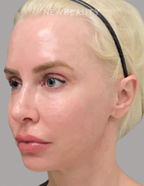 Dr. Janet Allenby - Microneedling with Radio Frequency - 24249321 - After